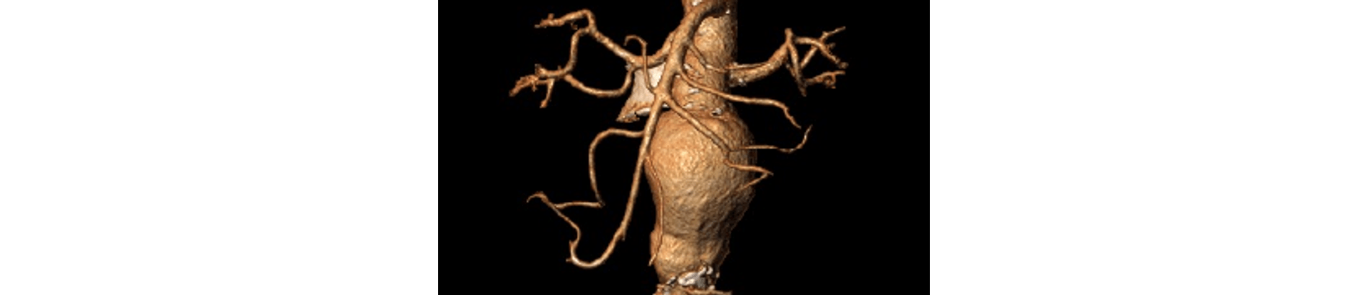 DESTAQUE APRIMORAMENTO MEDICO EM DOENCAS DA AORTA